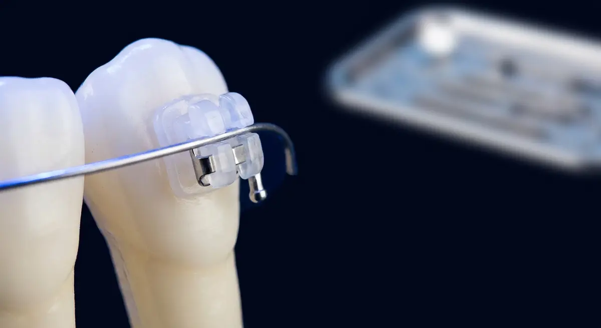 Modern self-ligating ceramic braces — orthodontic treatment at Correct Smiles Orthodontics, Gandhi Nagar Jammu
